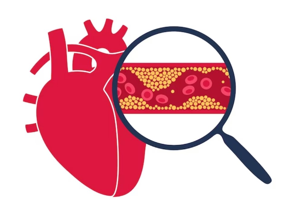 Gut bacteri linked to fatty deposits in heart arteries : researchs