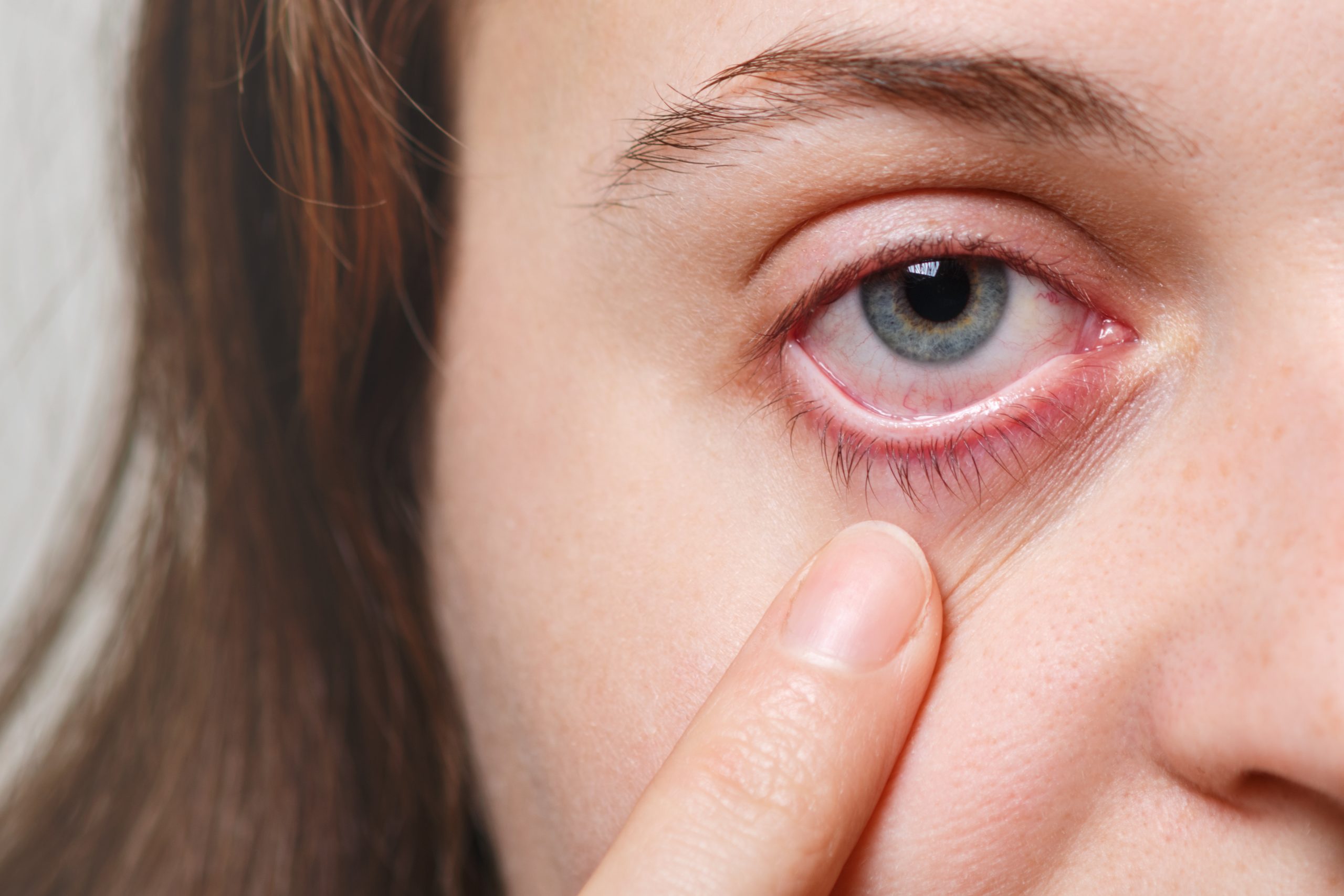 Dry eyes troubling you? Probiotics could be the answer to your problem